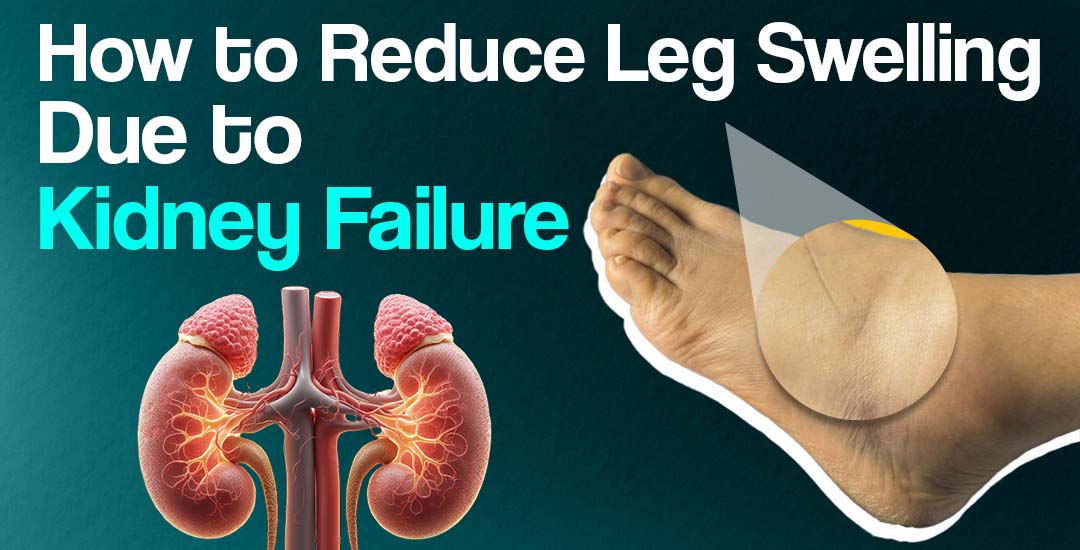 How to Reduce Leg Swelling Due to Kidney Failure